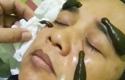 Terapi-pengobatan-lintah-pulihjati-hca-holistik